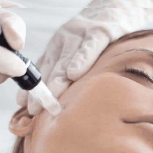 microneedling