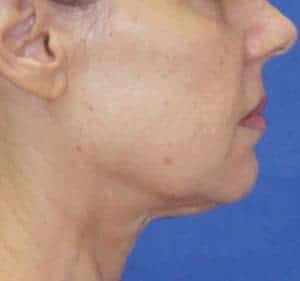 face and neck after treatment