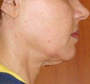 Face and Neck before treatment