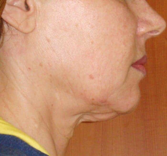 face-neck-before Face and Neck before treatment